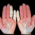 objawy zespołu Raynauda